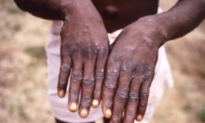 CDC Backtracks on Non-Airborne Monkeypox Mask Guidance After Criticism